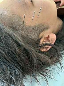側頭筋 鍼